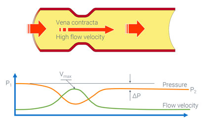 Diagram, curves and schematic that explains the vena contracta